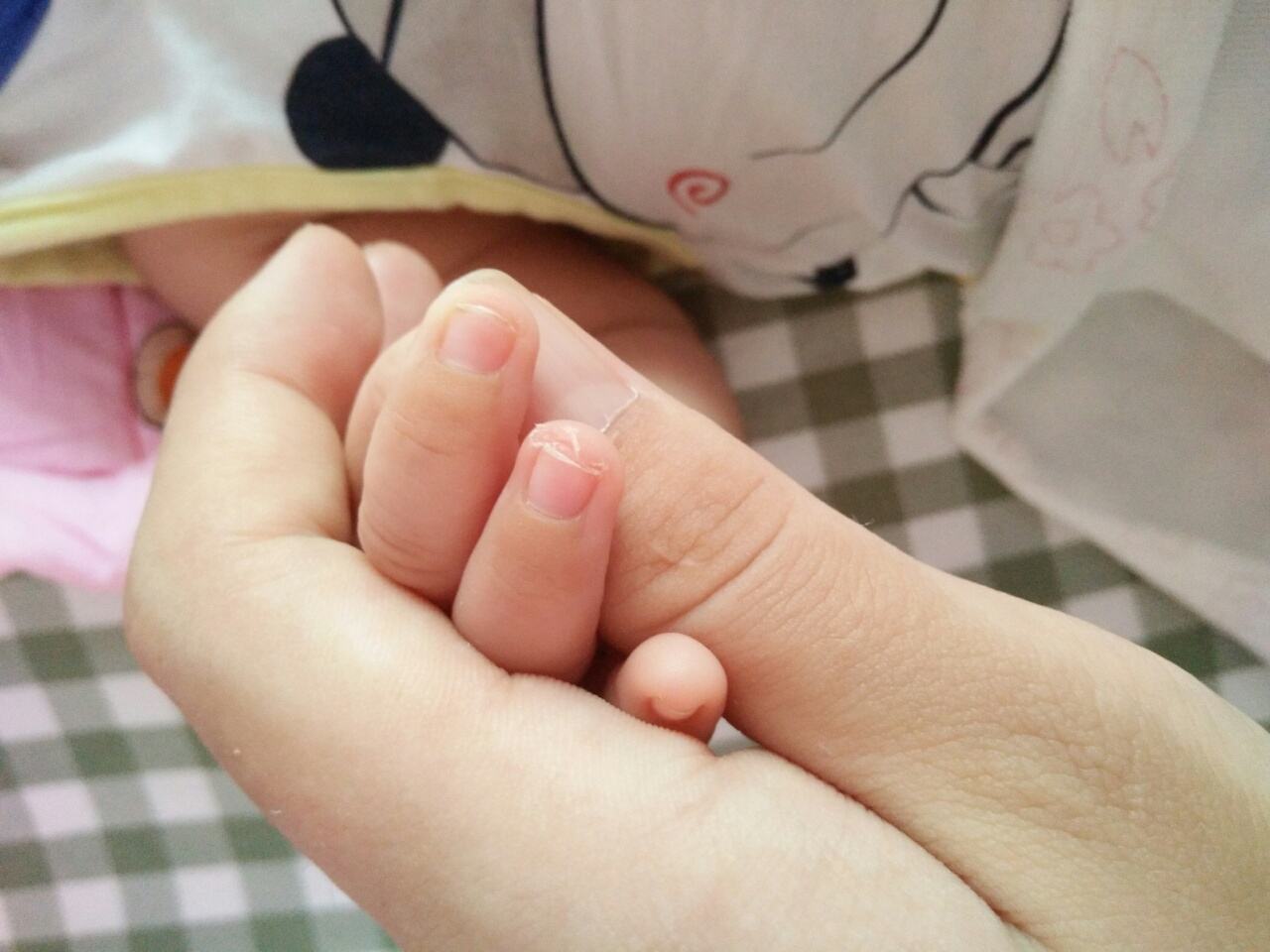 孩子指甲有白斑、凹陷 應該補哪些微量元素